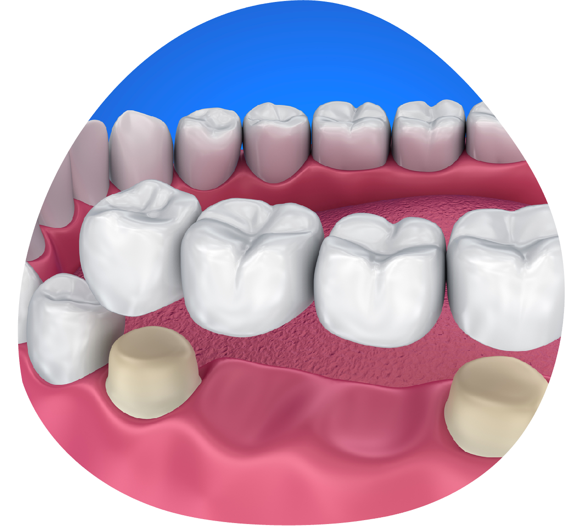 Teeth Bridging